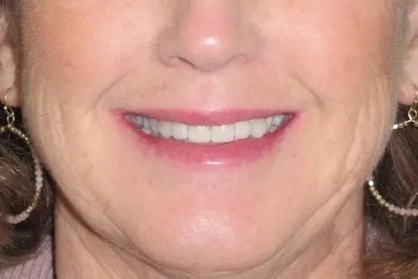 Same patient smile after treatment
