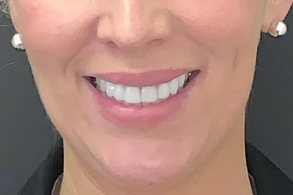 Same patient smile after treatment