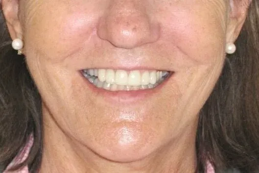 Same patient smile after treatment