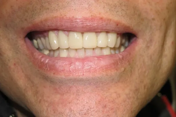 Same patient smile after treatment