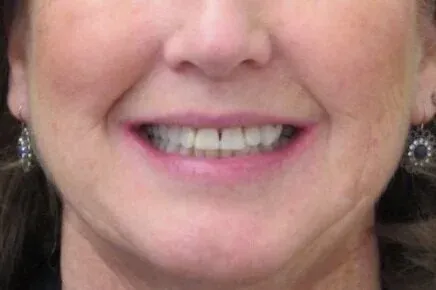 Patient smile before treatment