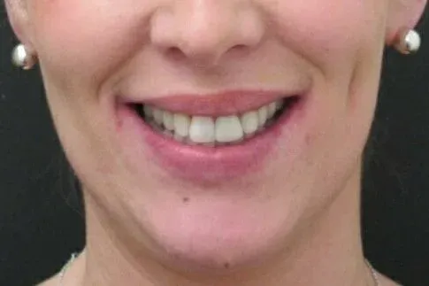 Patient smile before treatment