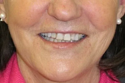 Patient smile before treatment