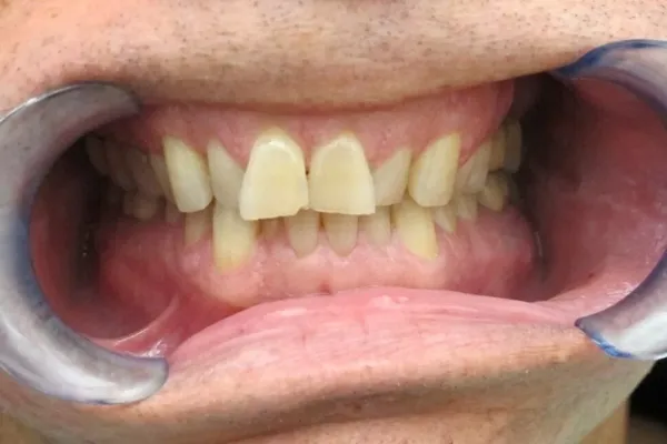 Patient smile before treatment